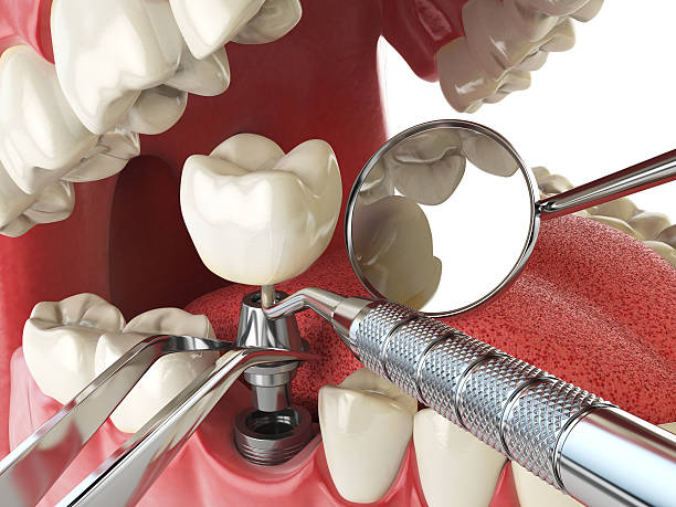 Best Dentist for Tooth Abscess  in Stowell, TX